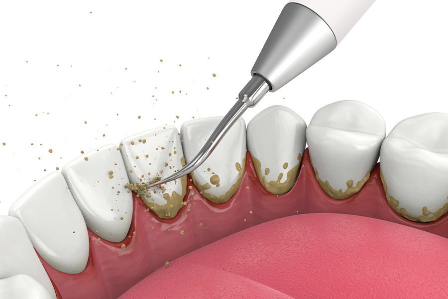 スケーラーによって歯石やプラークの除去